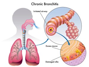 Acute Bronchitis